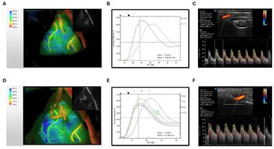 Multimodal evaluation of the bloodstream alteration before and after combined revascularization for Moyamoya disease